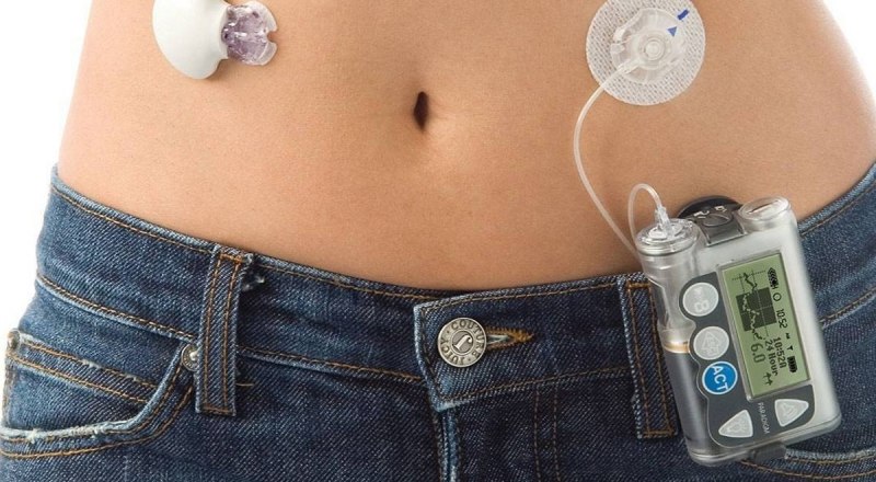 Так инсулиновые помпы устанавливают на теле человека. Фото с сайта doctor.ru