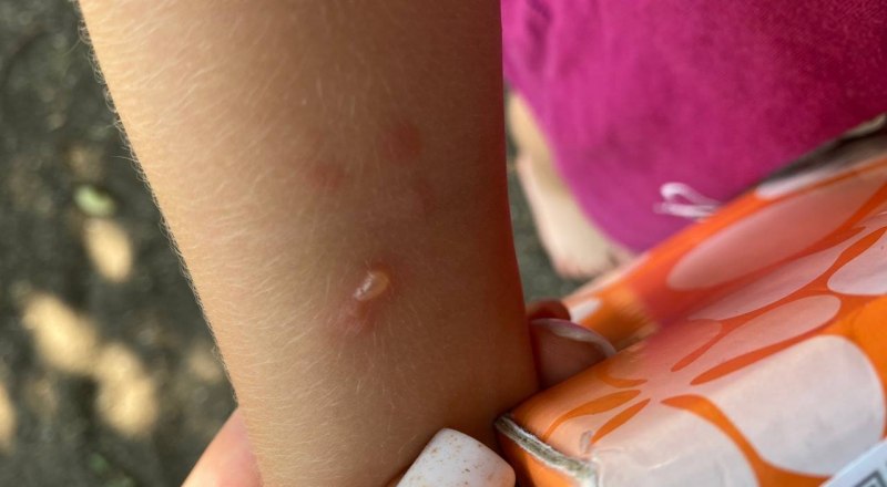Ожоги появились у ребёнка только спустя 12 часов после контакта с борщевиком. Фото Александры ВОСТРИКОВОЙ.